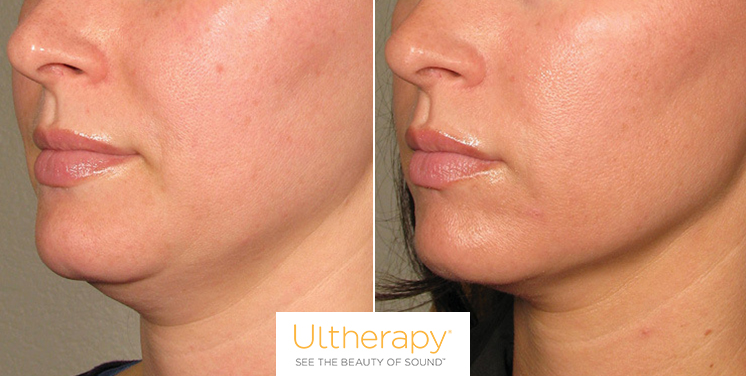 ultherapy san diego non-surgical facelift